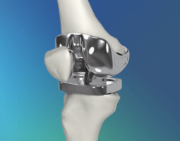 Inner view of a knee after a replacement surgery